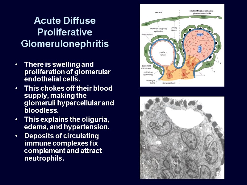 Acute Diffuse Proliferative Glomerulonephritis There is swelling and proliferation of glomerular endothelial cells. 